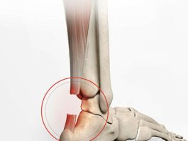 Aşil Tendon Rüptürü