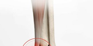 Aşil Tendon Rüptürü