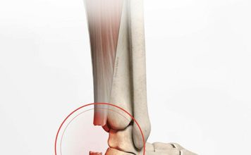 Aşil Tendon Rüptürü