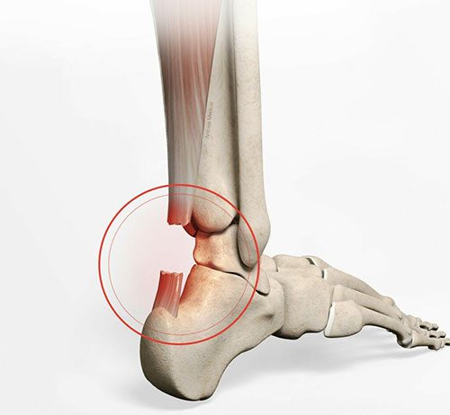 Aşil Tendon Rüptürü