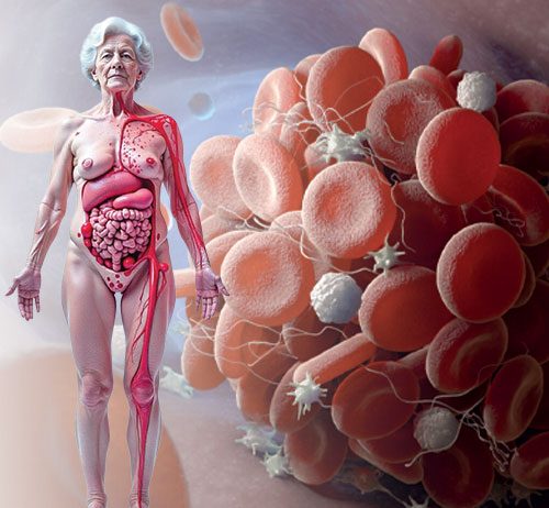 Dissemine İntravasküler Koagülasyon (DİK)