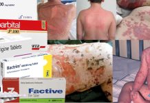 Stevens Johnson Sendromu ve Toksik Epidermal Nekroliz