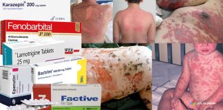 Stevens Johnson Sendromu ve Toksik Epidermal Nekroliz