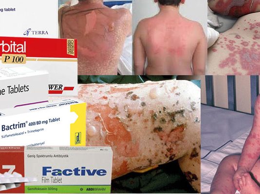 Stevens Johnson Sendromu ve Toksik Epidermal Nekroliz