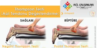 Thompson Testi (Aşil Tendonu Değerlendirme)