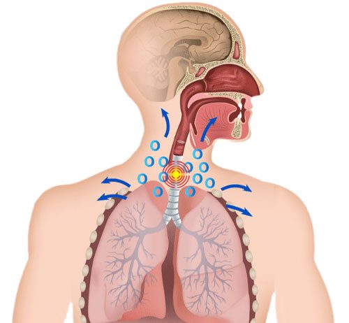 Trakeobronşiyal Yaralanmalar