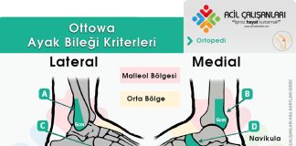 Ottowa Ayak Bileği Kriterleri