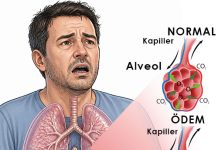 Akut Solunum Sıkıntısı Sendromu (ARDS )