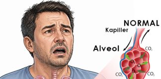 Akut Solunum Sıkıntısı Sendromu (ARDS )