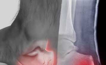 Kalkaneus Kırıkları