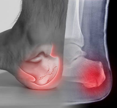 Kalkaneus Kırıkları