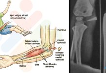Medial Epikondil Avülsiyon Kırığı