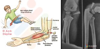 Medial Epikondil Avülsiyon Kırığı