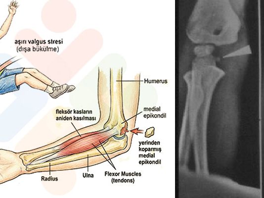Medial Epikondil Avülsiyon Kırığı