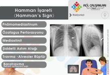 Hamman İşareti (Hamman’s Sign)