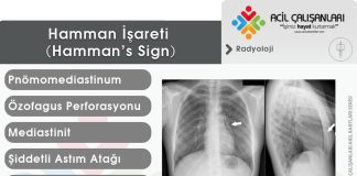 Hamman İşareti (Hamman’s Sign)