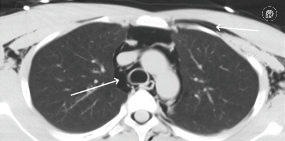 Pnömomediastinum BT
