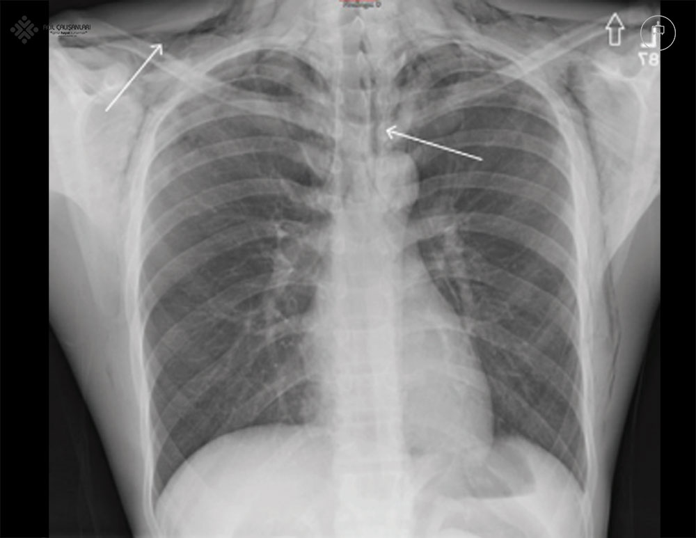 Pnömomediastinum Grafisi