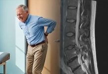 Kauda Ekuina ve Konus Medullaris Sendromları