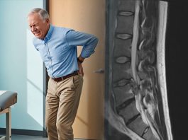 Kauda Ekuina ve Konus Medullaris Sendromları