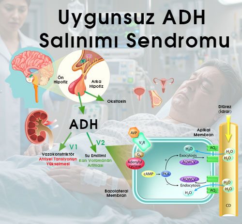 Uygunsuz ADH Salınımı Sendromu