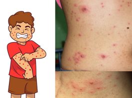 Su Çiçeği (Varisella Zoster)