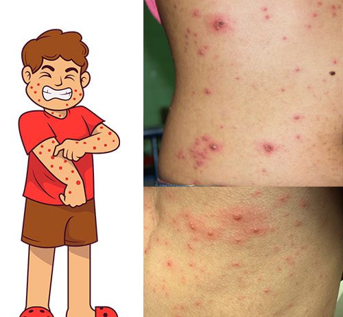 Su Çiçeği (Varisella Zoster)