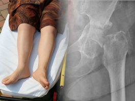 Femur Boyun Kırıkları