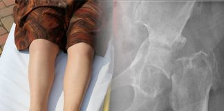 Femur Boyun Kırıkları