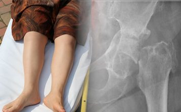 Femur Boyun Kırıkları