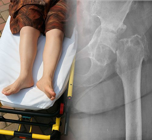 Femur Boyun Kırıkları