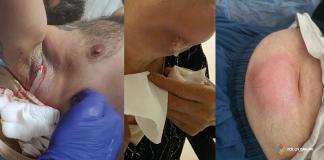 Apseye Acil Yaklaşım