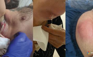 Apseye Acil Yaklaşım