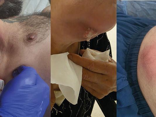 Apseye Acil Yaklaşım