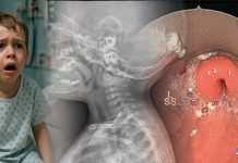 Akut Epiglotit Acil Yaklaşım