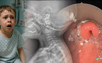 Akut Epiglotit Acil Yaklaşım