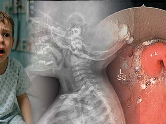 Akut Epiglotit Acil Yaklaşım