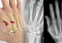 Metakarp Kırıkları Acil Yaklaşım