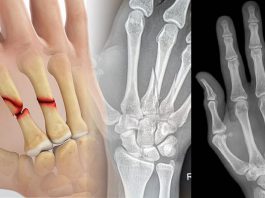 Metakarp Kırıkları Acil Yaklaşım