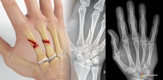 Metakarp Kırıkları Acil Yaklaşım