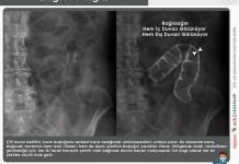 Çift Duvar Belirtisi (Rigler’s Sign)