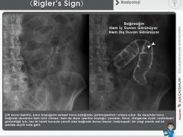 Çift Duvar Belirtisi (Rigler’s Sign)