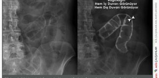 Çift Duvar Belirtisi (Rigler’s Sign)