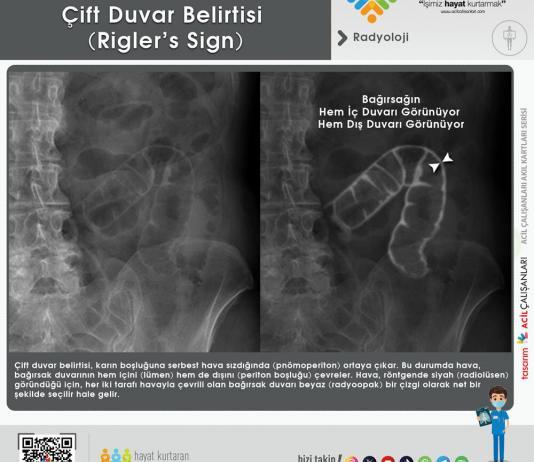 Çift Duvar Belirtisi (Rigler’s Sign)