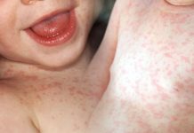 Roseola Infantum (Altıncı Hastalık)