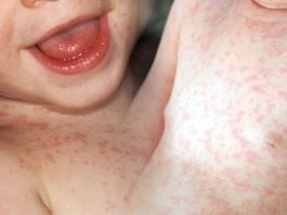 Roseola Infantum (Altıncı Hastalık)