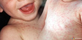 Roseola Infantum (Altıncı Hastalık)