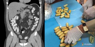 Gastrointestinal Yabancı Cisimler