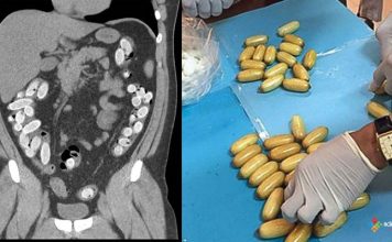 Gastrointestinal Yabancı Cisimler