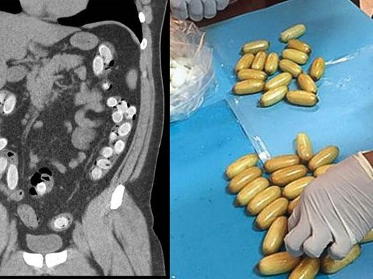 Gastrointestinal Yabancı Cisimler